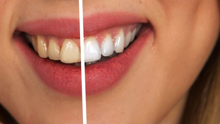 Laserowe wybielanie zębów – jak wygląda zabieg?