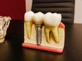 Jakie implanty zębowe wybrać