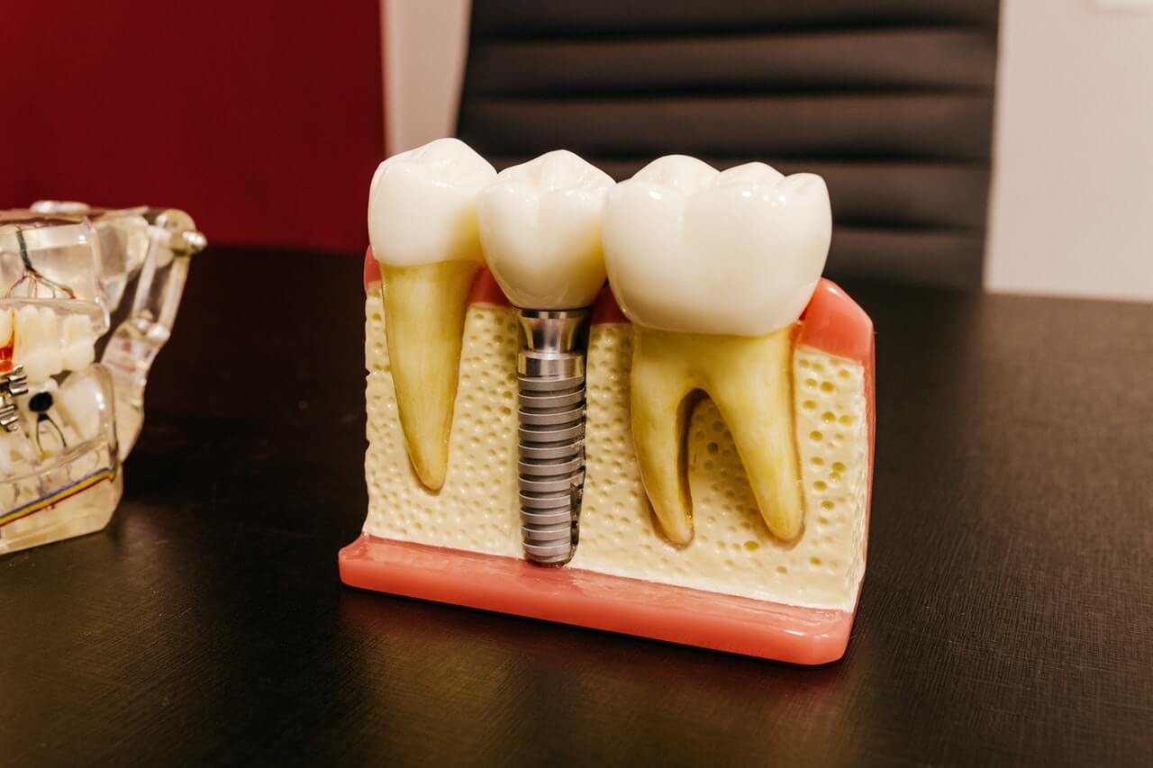 Jakie implanty zębowe wybrać?